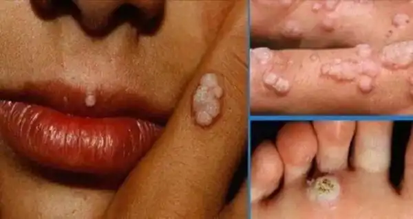 HEALTH ALERT!! Before You Kiss Anybody You Might Want To Know About HPV Virus (cause, symptoms, prevention)